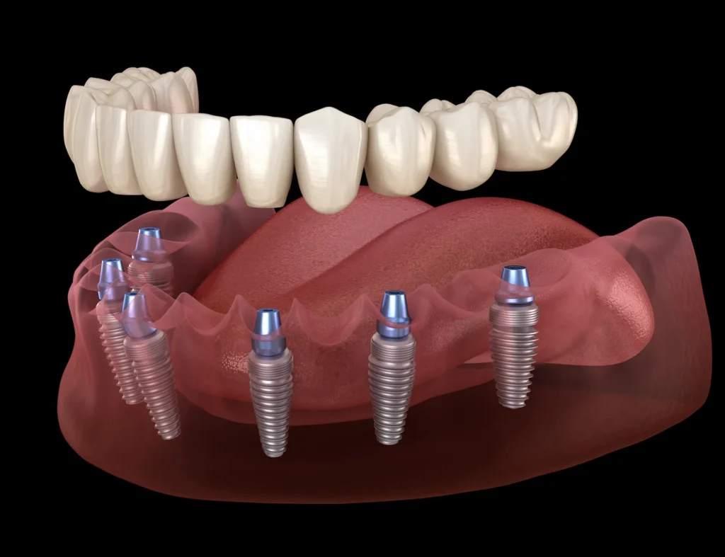 all on 6 dental implants