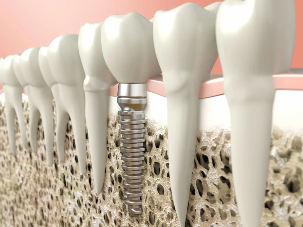 traditional-dental-implant