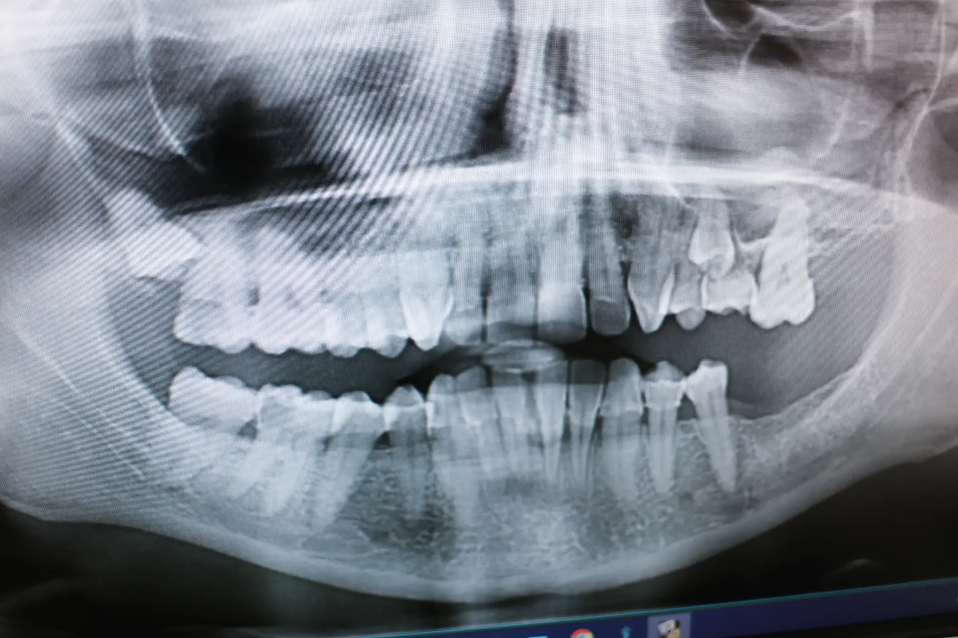 dental implant is loose