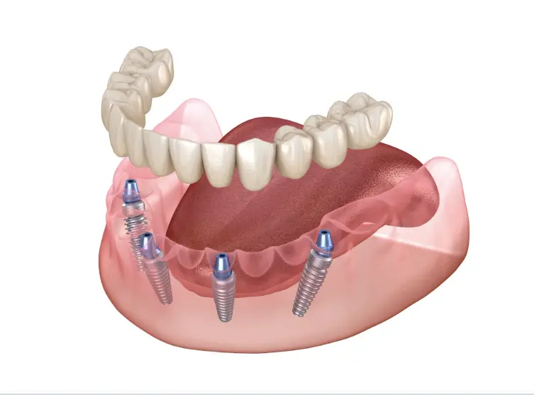 what is all on 4 dental implants