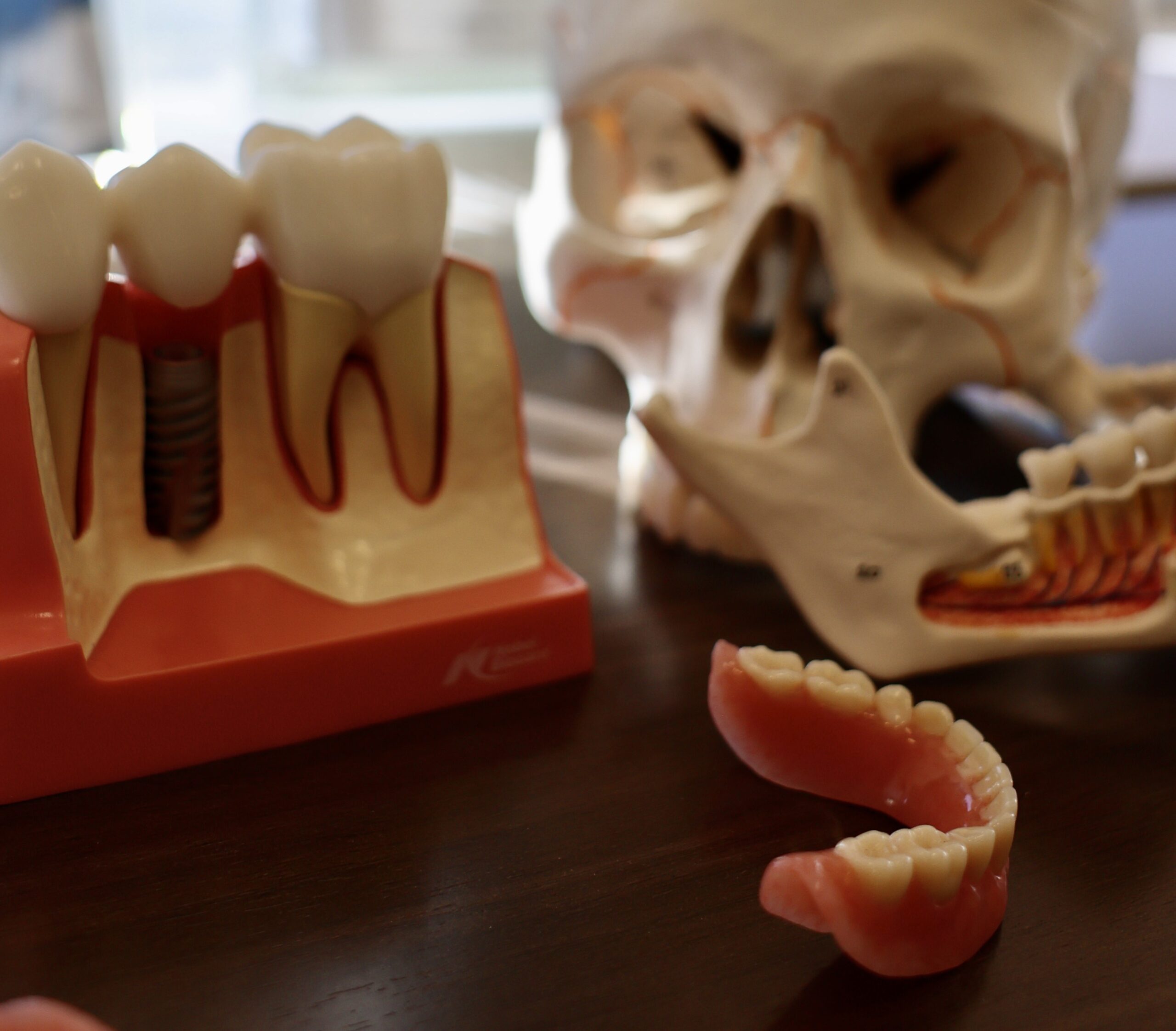 How Is a Crown Attached to a Dental Implant?