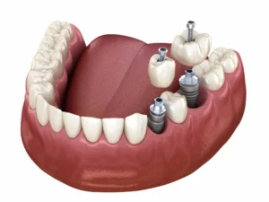 types of denture implants