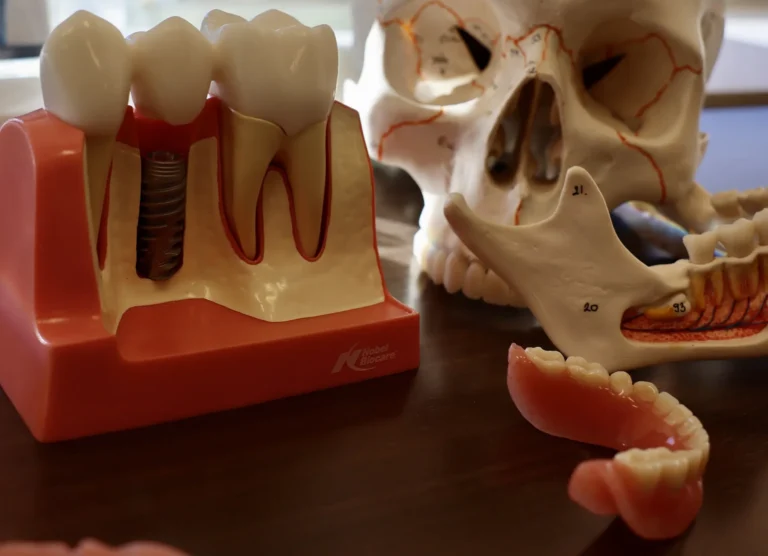 what do full mouth dental implants look like