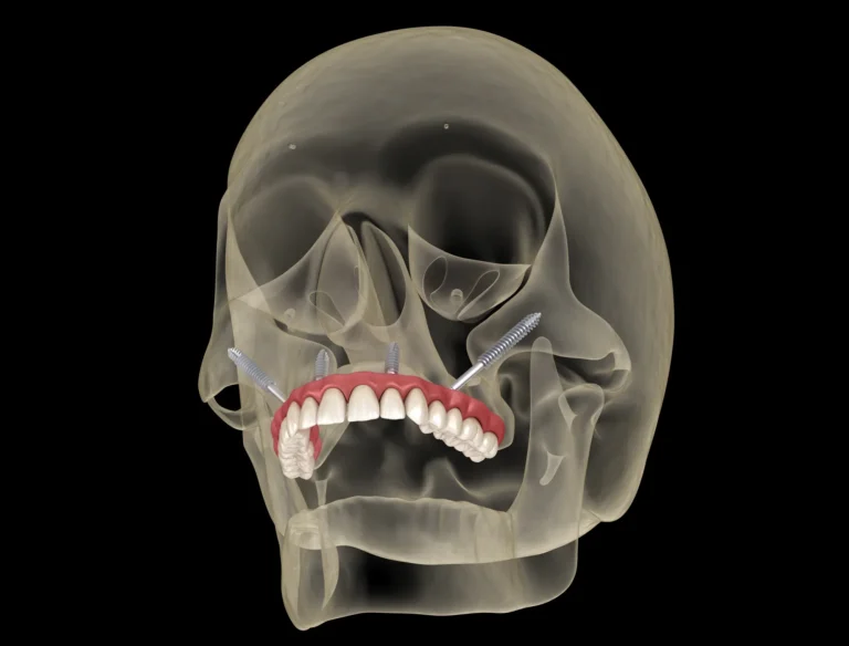 what is zygomatic implants