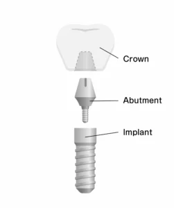 The Importance of a Dental Implant Abutment