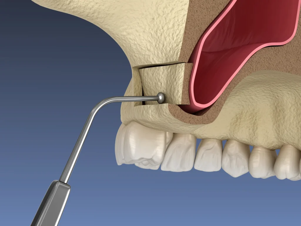 what is the purpose of a sinus lift